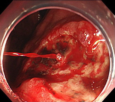 胃潰瘍からの出血